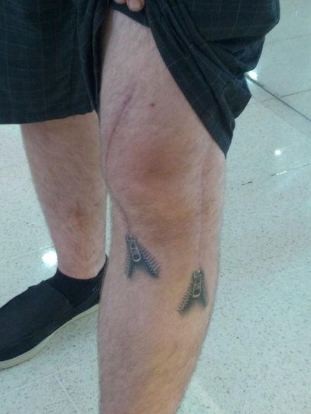 Zipper scars