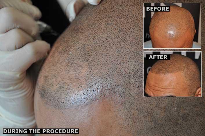 Micro hair tattoo